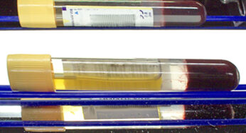 Is the specimen centrifuged?